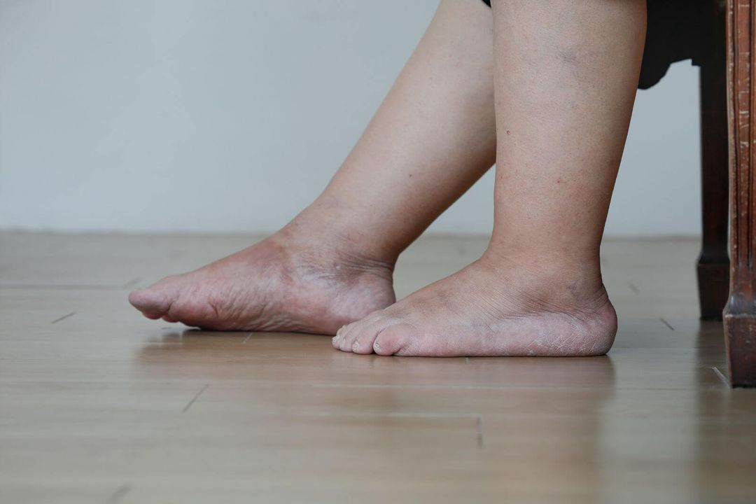 Leg Swelling From Knee Down Causes, Symptom, & Treatment Options